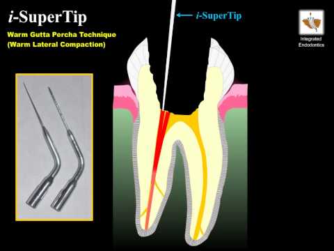 Warm Gutta Percha Technique