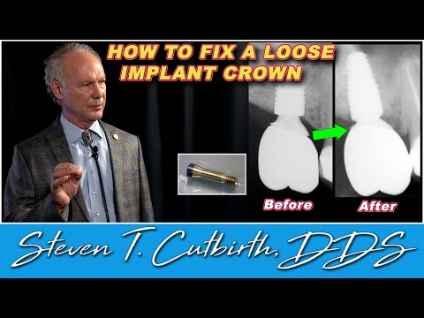 How to Fix a Loose Implant Crown - Dental Minute with Steven T. Cutbirth, DDS
