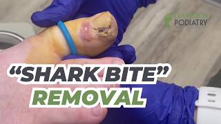 'Shark Bite' Nail Removal