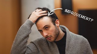 DID THE HAIR LOSS TREATMENT WORK? | 9 MONTH FINAL UPDATE (4/4)