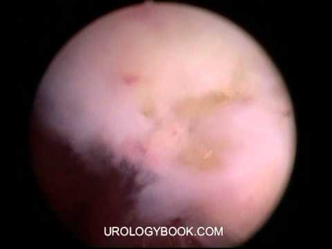 Holmium Laser Enucleation Of Prostate 7/9