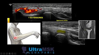 EPICONDILITIS LATERAL/TENDINOPATIA EXTENSORA CODO