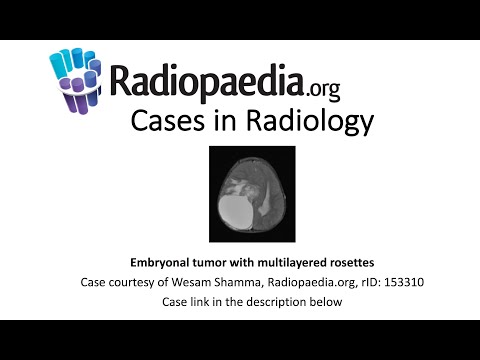Embryonal tumor with multilayered rosettes (Radiopaedia.org) Cases in Radiology