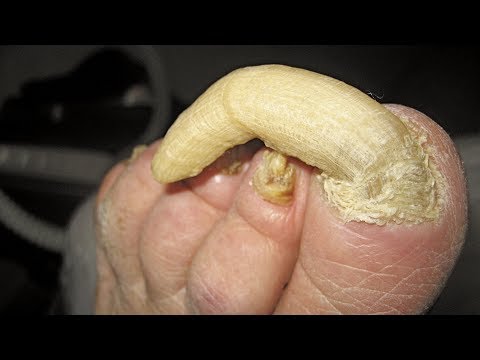 Fungus paa at mga kamay na larawan Ointment para sa balakubak fungus