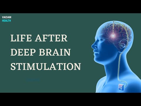 Life After Deep Brain Stimulation