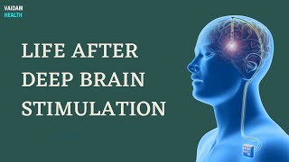Life After Deep Brain Stimulation