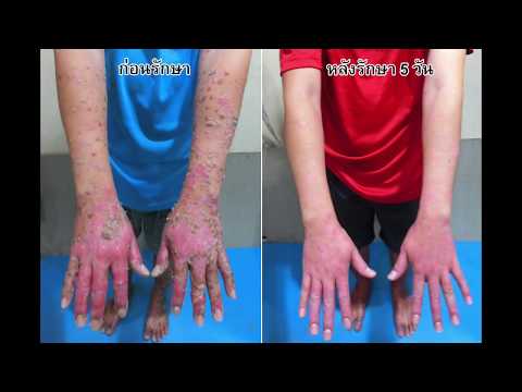 Akrustal โดยการขายมอสโก ครีมโรคสะเก็ดเงิน zudafu AliExpress