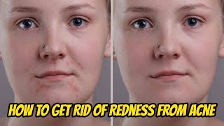 How to Get Rid Of Redness from Acne Fast Overnight
