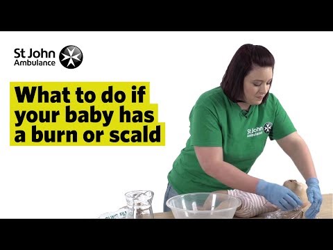 What to do if Your Baby has a Burn or Scald - First Aid Training - St John Ambulance