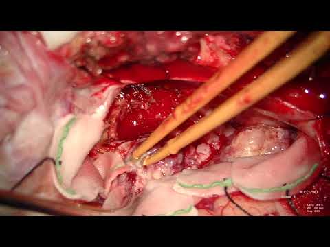 Resection Of Large Tentorial Incisura Meningioma Extending To Middle And Posterior Fossa