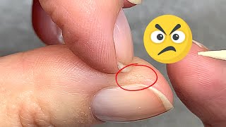 Hard, Annoying Skin Around the Nails? 2 Easy Solutions