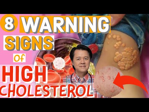 8 Warning Signs of High Cholesterol - By Doc Willie Ong #1098