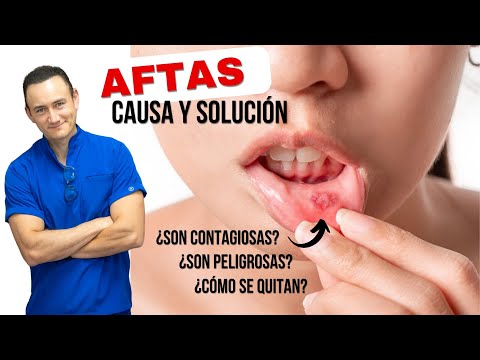 Canker Sores: Cause and Treatment. Are They Contagious or Dangerous? How to Get Rid of Them?