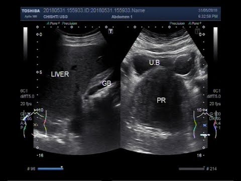 Echographic prosztatitis