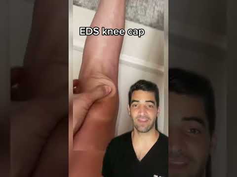 Knee cap hypermobility, EDS
