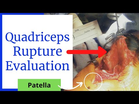 Quadriceps Repair 3 Weeks Post Op