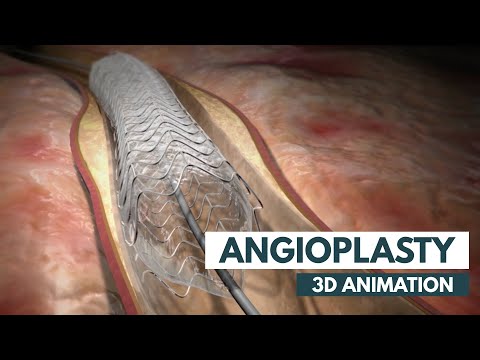 Angioplasty  3D Animation Real Footage