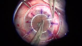 Download Lagu Keratoplasty on the edge AAO 2015 Thumbnail