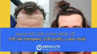 ปลูกผมFUE 2183 กราฟท์ ผล1ปีหลังทำ หมอก้องเกียรติ FUE hair transplant 2183 grafts, 1 year result
