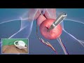 MKT1460A - Magnetic Surgery in a prostatectomy procedure (prostate removal)