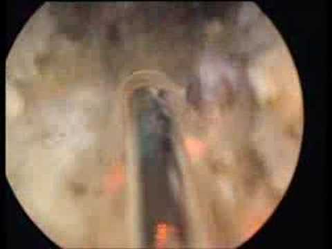 Vaporisation de la prostate de 130 g au laser Greenlight HPS