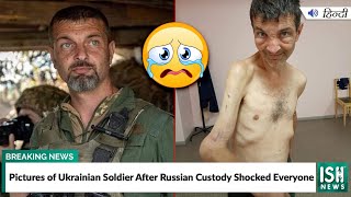 Picture of Ukrainian Soldier After Russian Custody Shocks Everyone