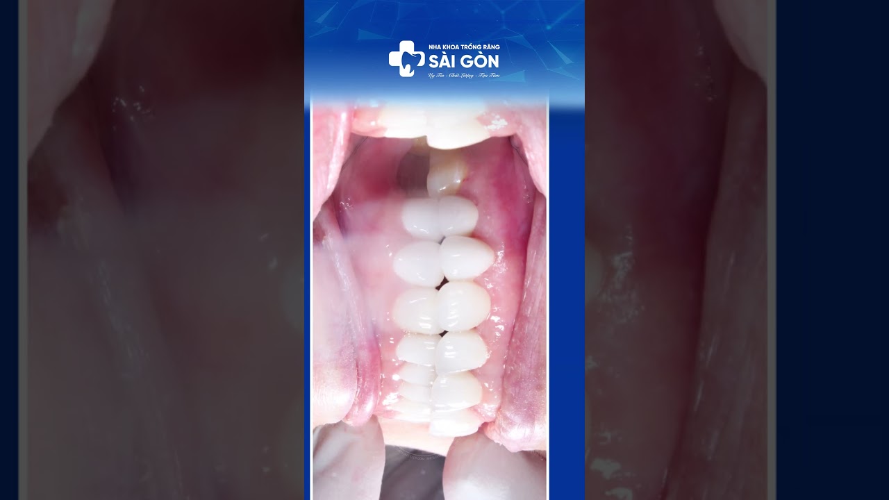 Case 20 Răng Toàn Sứ Lava Plus (Đức) | Nha Khoa Trồng Răng Sài Gòn