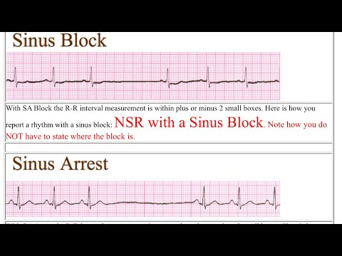 EKG : sinus block vs sinus arrest / Adam-Stokes syncope