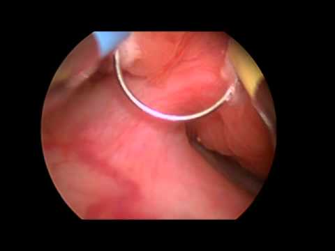 Adenoma prostatico dopo la chirurgia laser Compresse da prostatite c