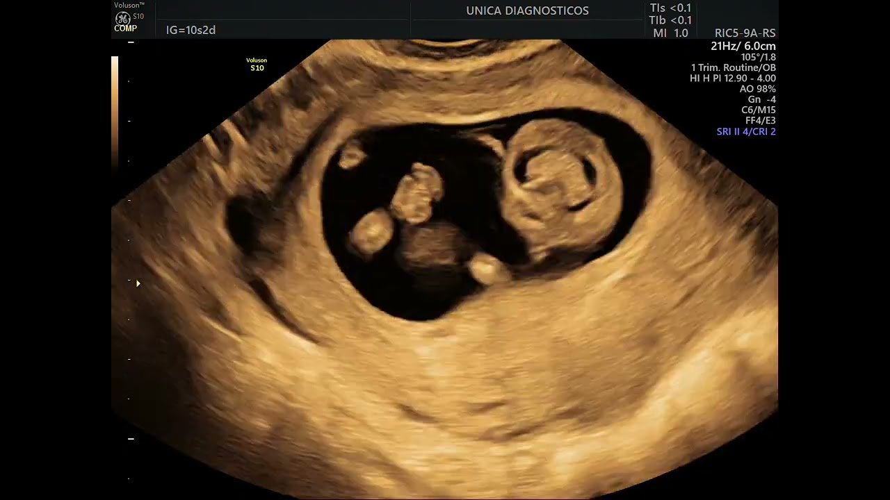 Ultrassom obstétrico de primeiro trimestre