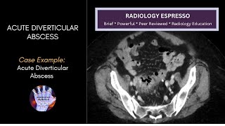 ACUTE DIVERTICULITIS: Case Example – Acute Diverticulitis with Diverticular Abscess (4720)