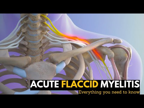 Lymphedema Causes Signs and Symptoms Diagnosis and Treatment