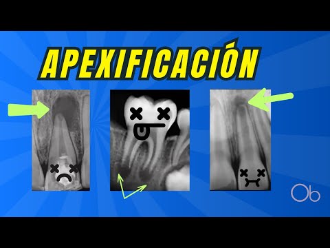 Apexificación 🦷