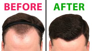 I Did HusKerrs' Hair Transplant!
