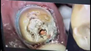 What Gives Root Canals A Bad Rap