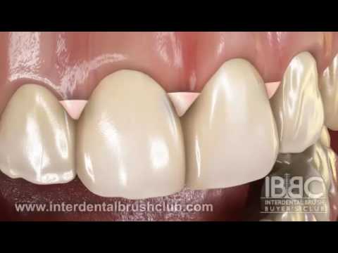 HOW DO INTERDENTAL BRUSHES COMPARE TO DENTAL FLOSS