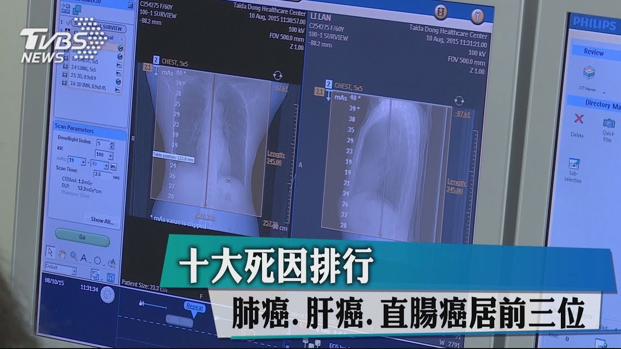 十大死因排行 肺癌、肝癌、直腸癌居前三位