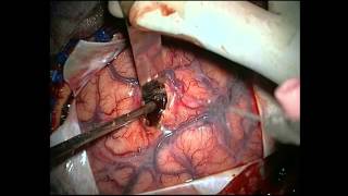 EVACUATION OF INTRACEREBRAL HEMORRHAGE