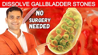 No Surgery Needed | Dissolve Gallbladder Stone - Dr. Vivek Joshi