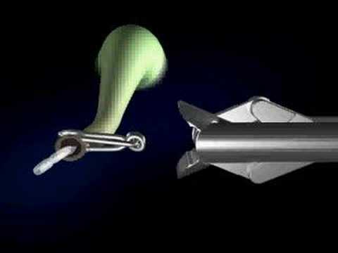 Side view of clip remover