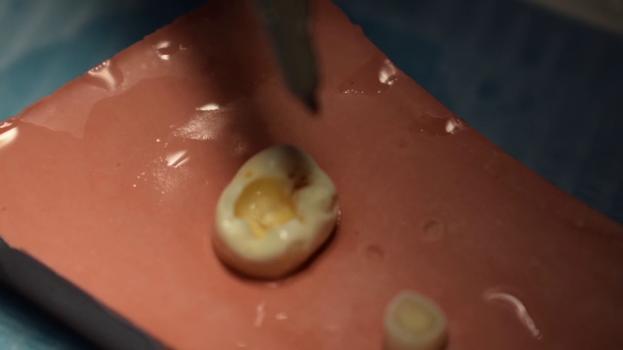 COMO REALIZAR UNA OBTURACIÓN CON COMPOSITE (EMPASTE)