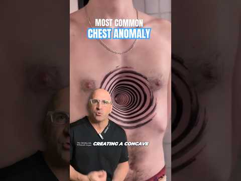 Most Common Pectus Chest Anomaly #shorts