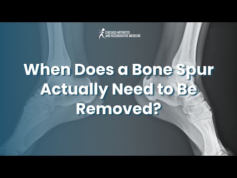 When Does a Bone Spur Actually Need to Be Removed?