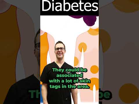 Skin Tag Removal Wart Removal How To Get Rid Of Skin Tags Warts