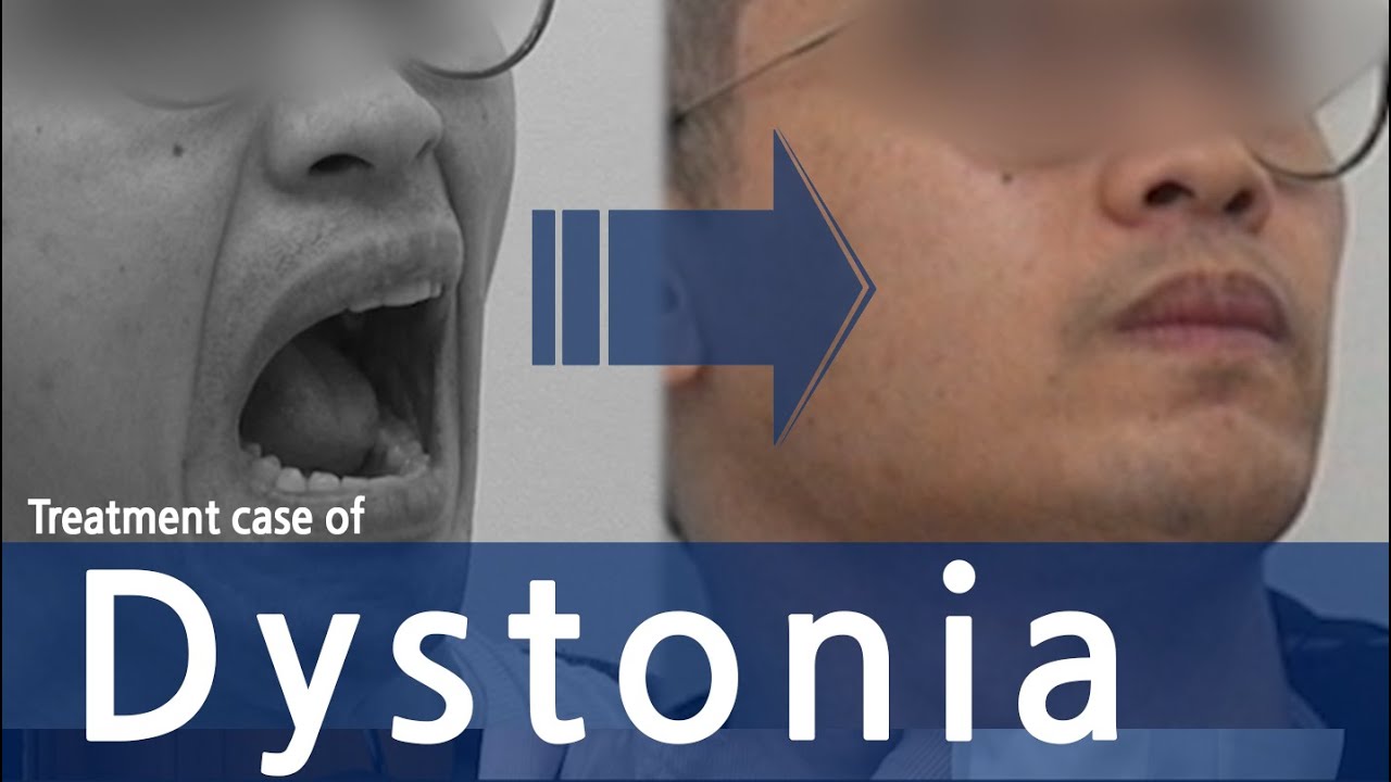 Dystonia (facial, oromandibular, eyes, tongue, neck, half of body) /  사경증 치료사례 / 근긴장이상증