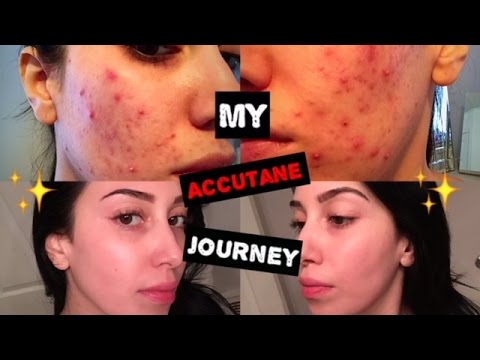 My Accutane Journey | 6 Months in 5 Minutes