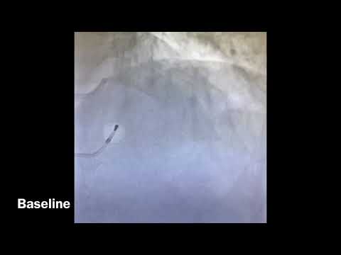 Coronary artery spasm with acetylcholine provocation testing