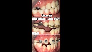 Download lagu How long do you have to wear an expander in Class III? - RPE   Bite Plate -  Tooth Time NBTX mp3