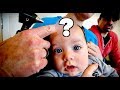 CUTE BABY with a BULGING FONTANELLE (Extremely Rare) | Dr. Paul - paulthomasmd - Dr. Paul CUTE BABY with a BULGING FONTANELLE (Extremely Rare) | Dr. Paul