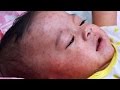 Disneyland measles outbreak spreads - YouTube
